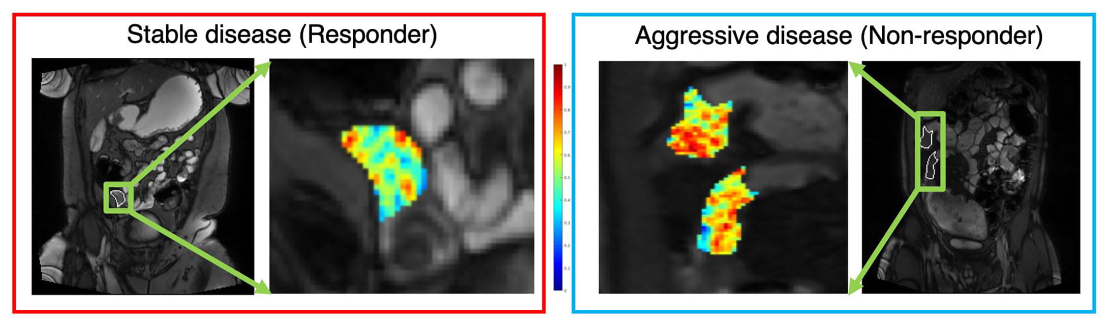 Image caption: Radiomic features extracted from MRE of a patient with mild disease and aggressive/severe disease