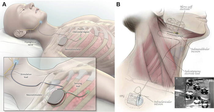Figure 2 Current systems for hypoglossal nerve stimulation.