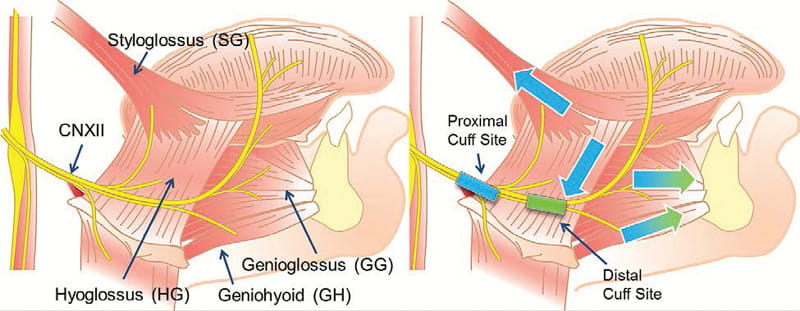 Figure 3 The anatomy and rationale for cuff placement.
