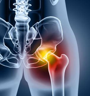 Getty image illustration of inflamed hip joint
