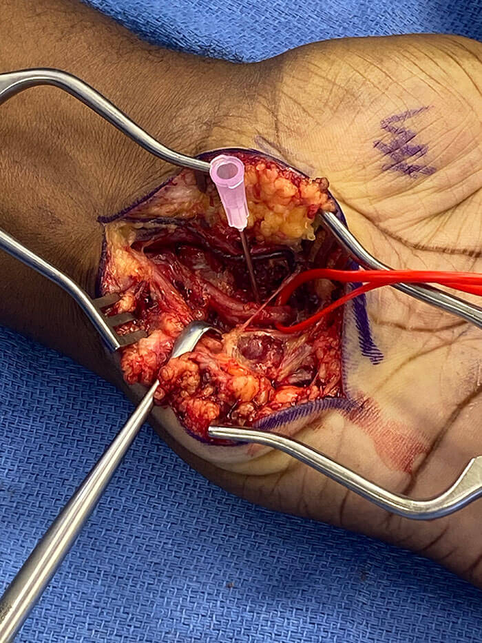 Intraoperative photograph with vessel loop around the deep motor branch of the ulnar nerve, hypodermic needle in the hook of the hamate