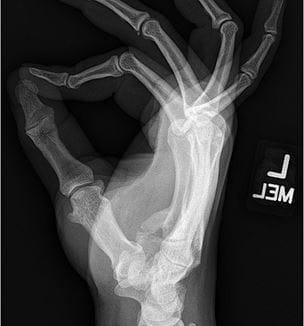 Lateral radiograph of hand demonstrating heterotopic bone extending from the base of the 5th metacarpal towards the hook of hamate displacing the ulnar nerve in a volar direction
