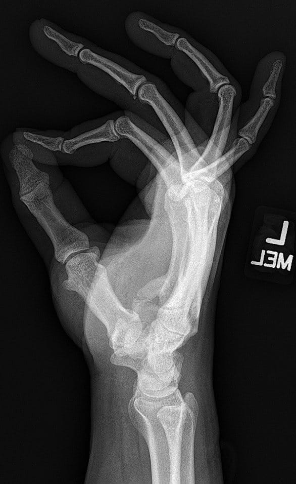 Lateral radiograph of hand demonstrating heterotopic bone extending from the base of the 5th metacarpal towards the hook of hamate displacing the ulnar nerve in a volar direction