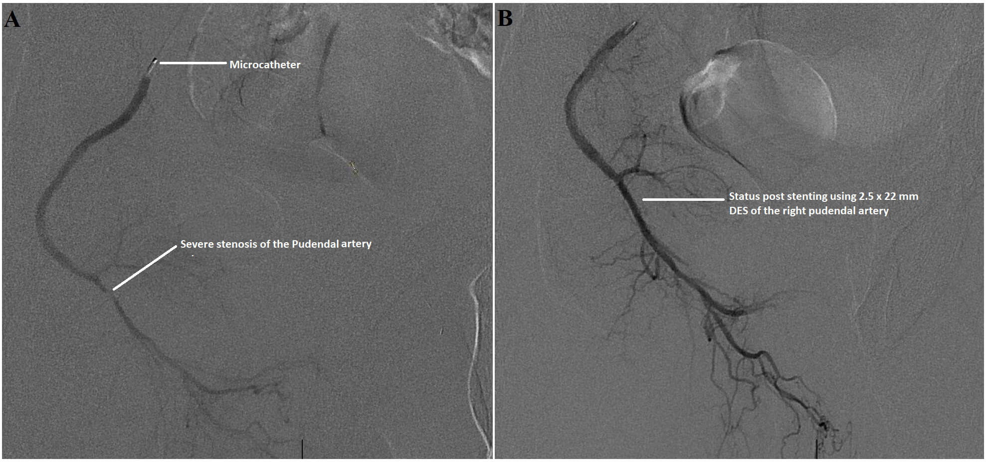Severe atherosclerotic stenosis of the right pudendal artery