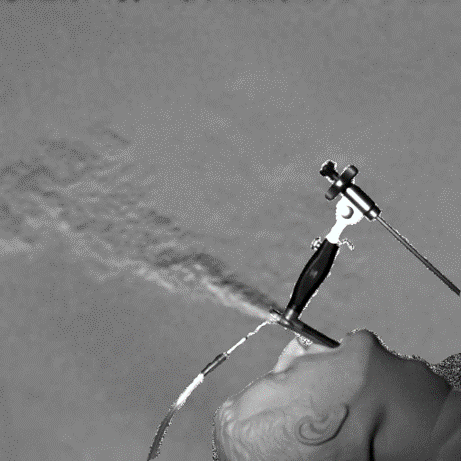 Example processed BOS image of jet ventilation on a manikin