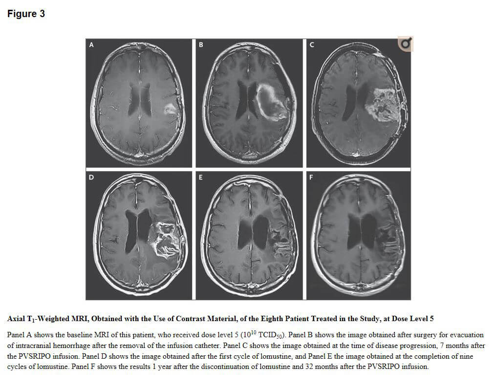 Recurrent Glioblastoma Treated with Recombinant Polio virus