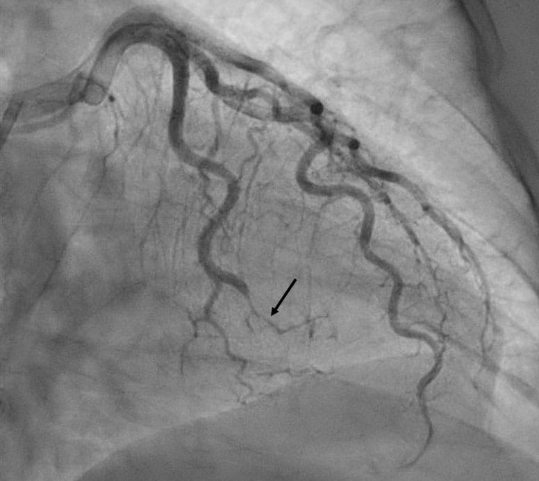 Spontaneous coronary artery dissection (SCAD) of an obtuse marginal artery (arrow) in a 62-year-old woman with non ST-segment elevation myocardial infarction. She was managed with medical therapy. She was subsequently found to have FMD in multiple arteries and evidence of a prior silent vertebral artery dissection. Note is made of tortuosity of the coronary arteries, a finding that has been associated with SCAD.