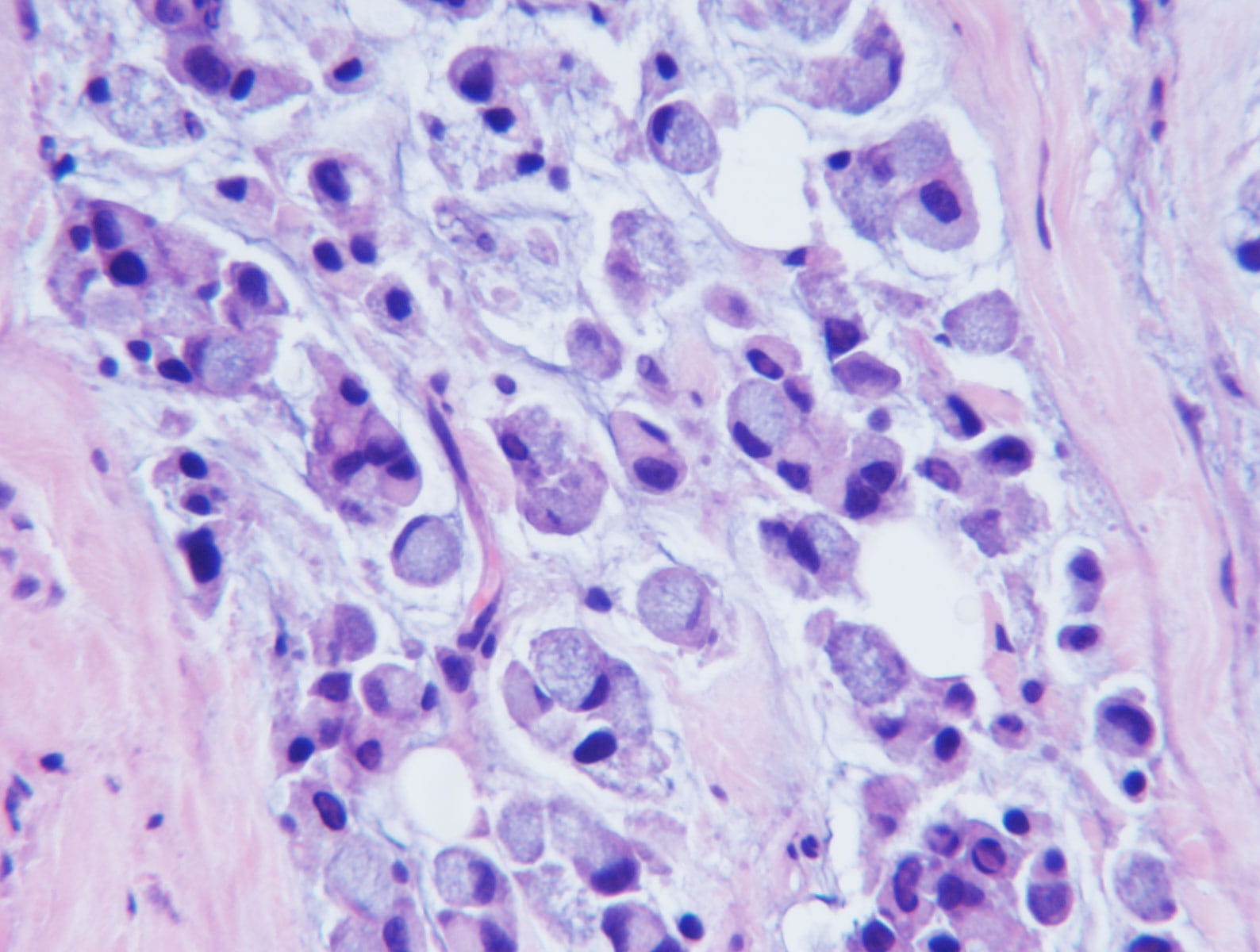 Signet Ring Colon Cancer