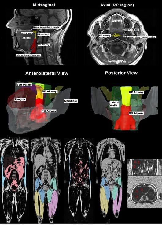 Obstructive sleep apnea scan related to I Neeland RO1 grant