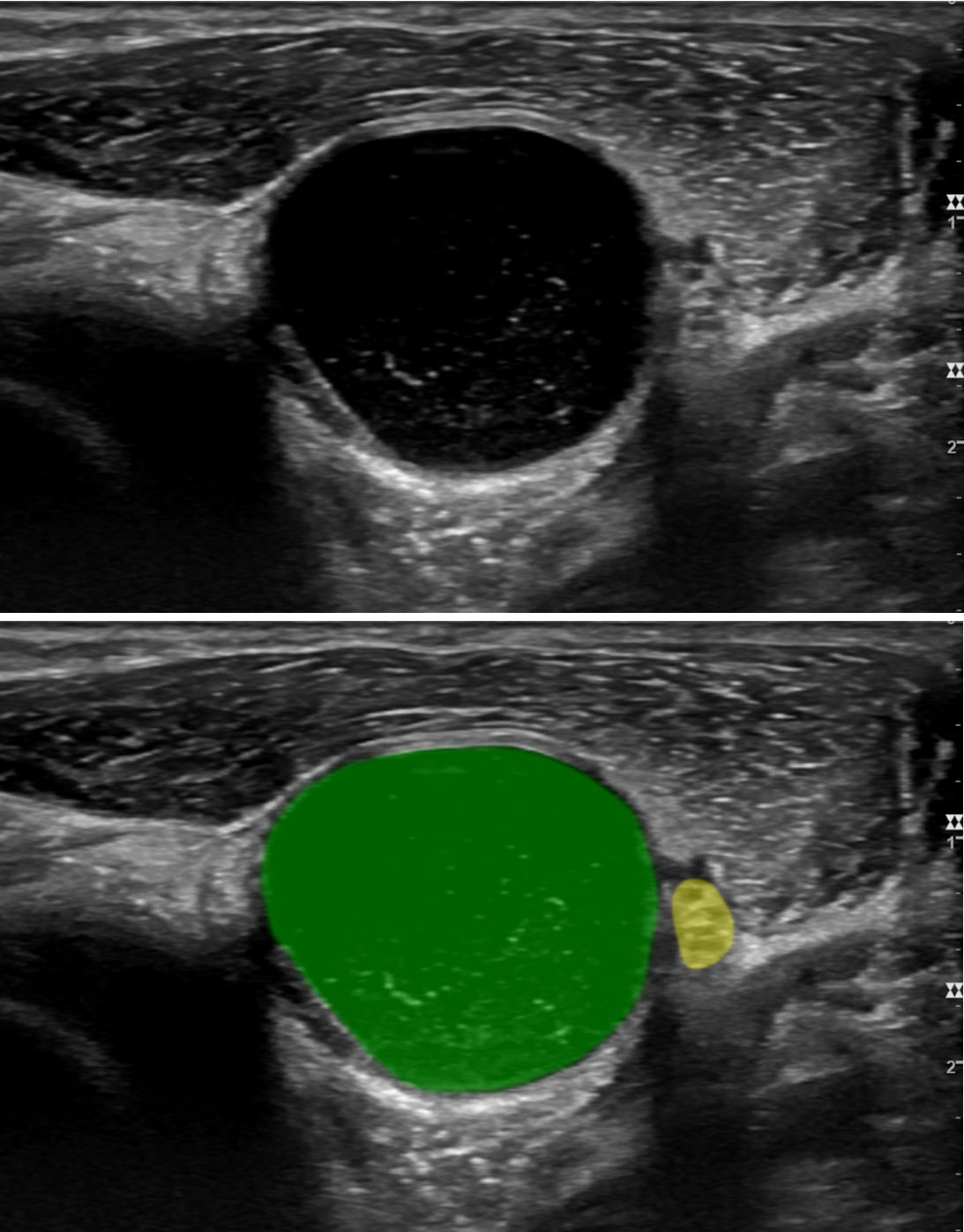 Image Caption: A large ganglion cyst (green) is displacing the radial nerve (yellow) near the elbow.