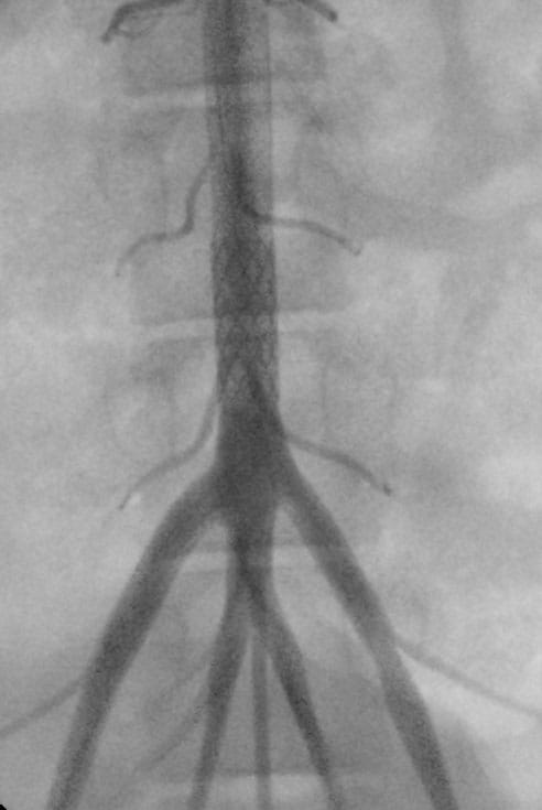 ZeBRAa Stent