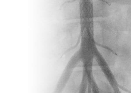 Zebra stent