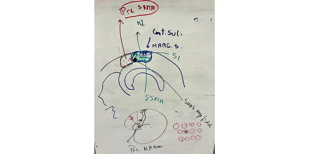 Dr. Hans Luders’ drawing of fontal mesial functional neuroanatomy during a morning conference.