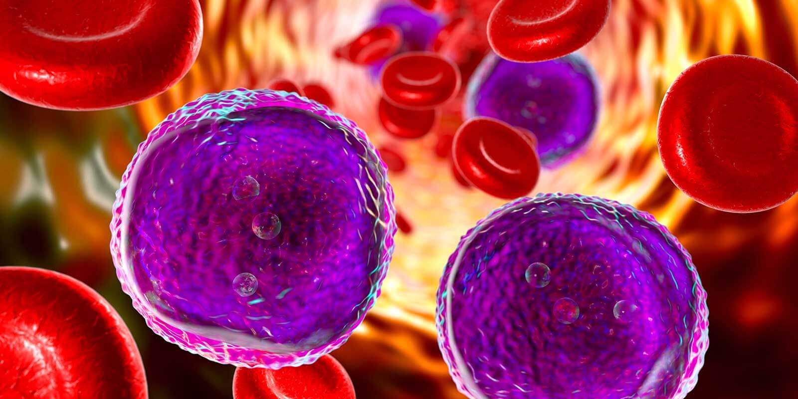 Acute lymphoblastic leukemia
