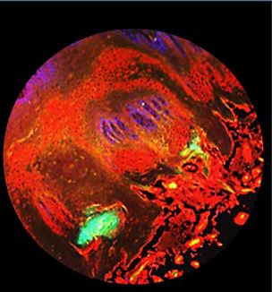 An immunofluorescent picture of a normal tongue compared with stage two tongue cancer. The healthy tongue tissue is stained red by a fluorescent antibody to hBD-2 (the good protein).