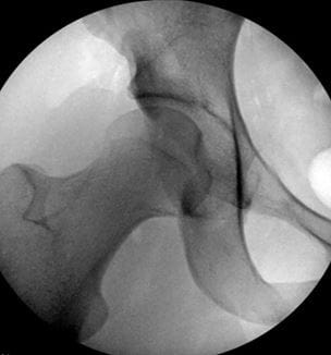 After Intra-Op Images of PAO correction of the hip socket orientation.