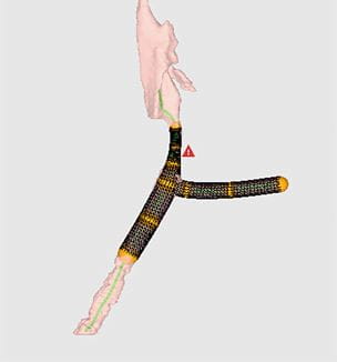 3D Printed Tracheal T-tube