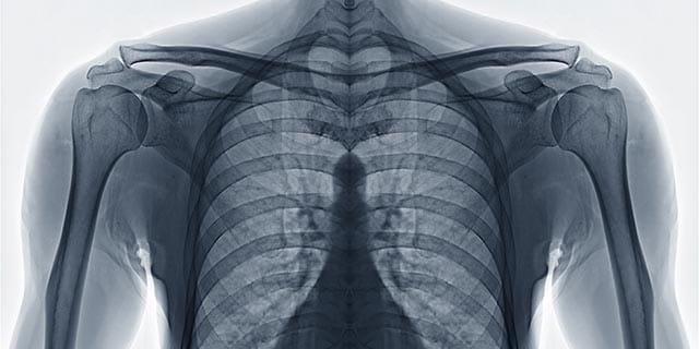 x-ray of chest wall