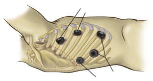 minimally invasive esophagectomy