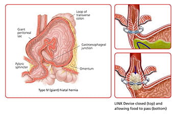 Type IV (giant) hiatal hernia