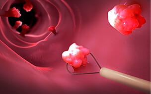 Illustration of the removal of a colonic polyp