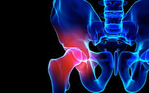 3D illustration of hip x-ray showing hip pain