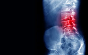 Back pain x-ray