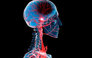 Illustration of a human skull showing a stroke event