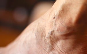 Varicose and Spider Veins