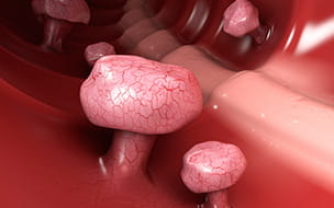 Colon Cancer