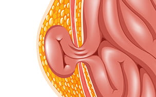 Hernia