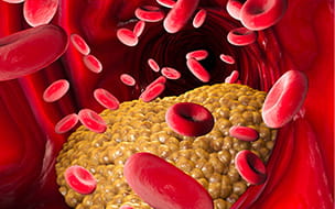 Peripheral Artery Disease Illustration