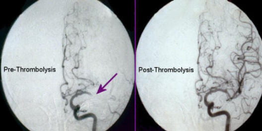 University Hospitals Neurology Residency Stroke