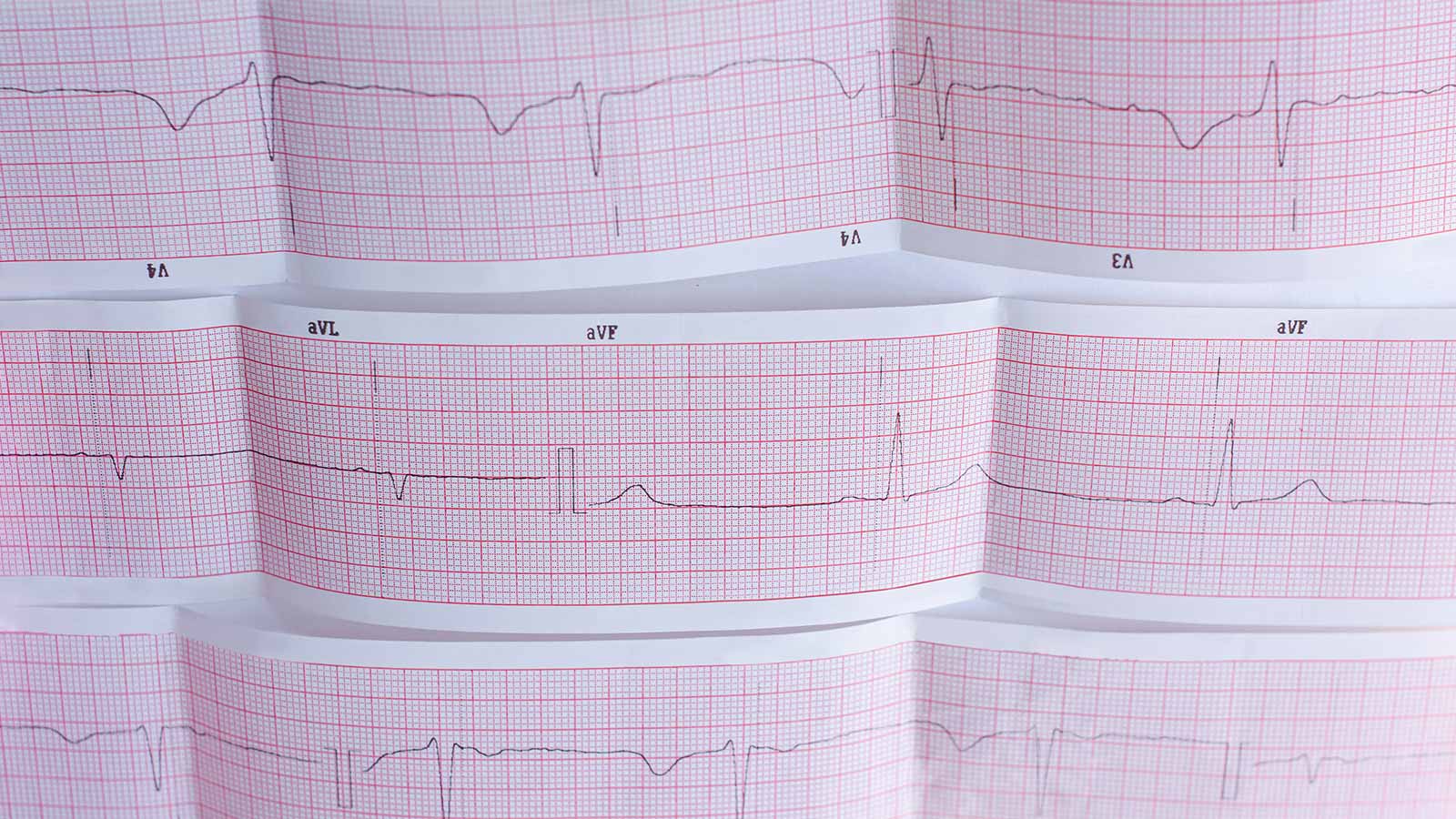 ECG strip