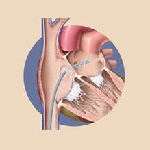 Left Atrial Decompression Catheter