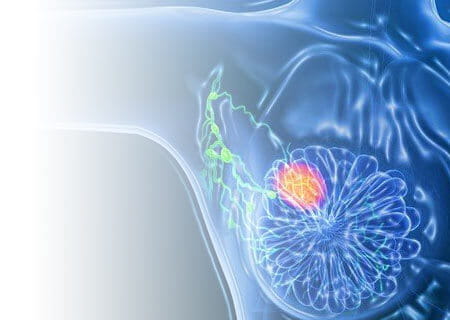 breast cancer illustration