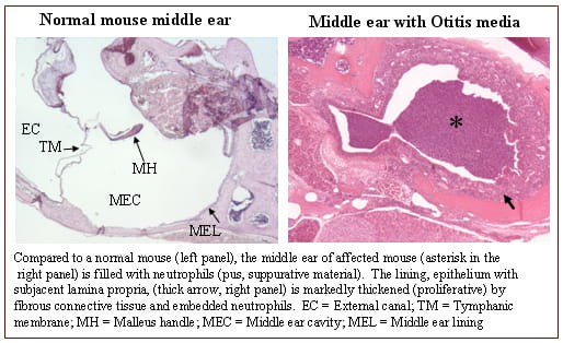 Otitis Media