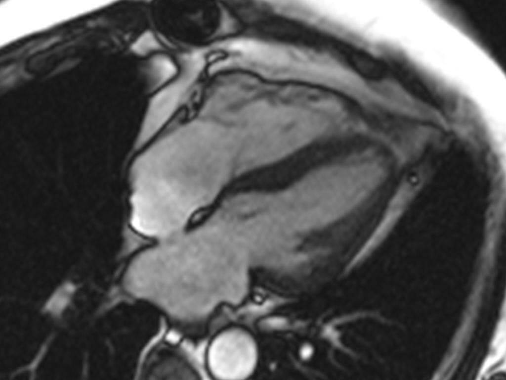 Cardiac MR