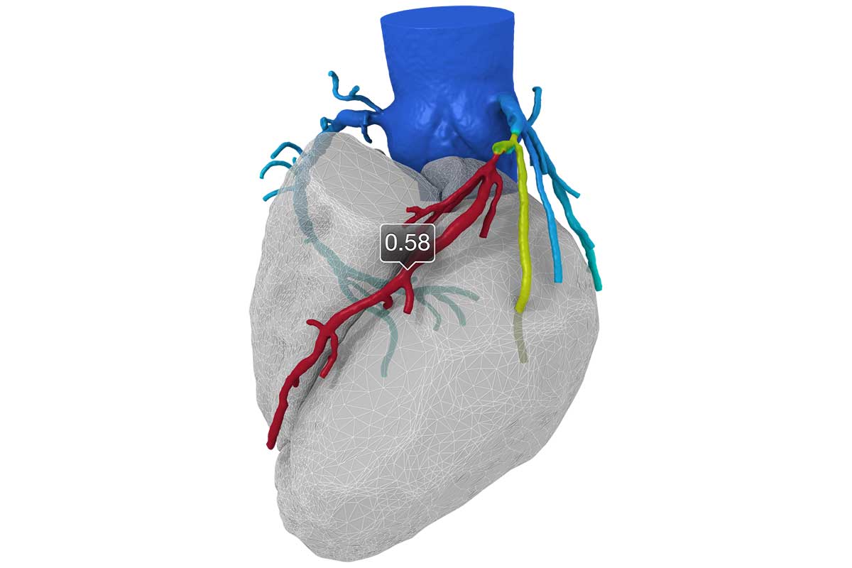 HeartFlow FFR-CT