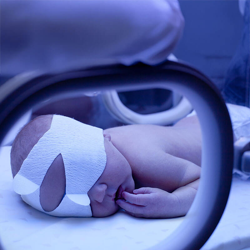Phototherapy treatment on a baby with jaundice