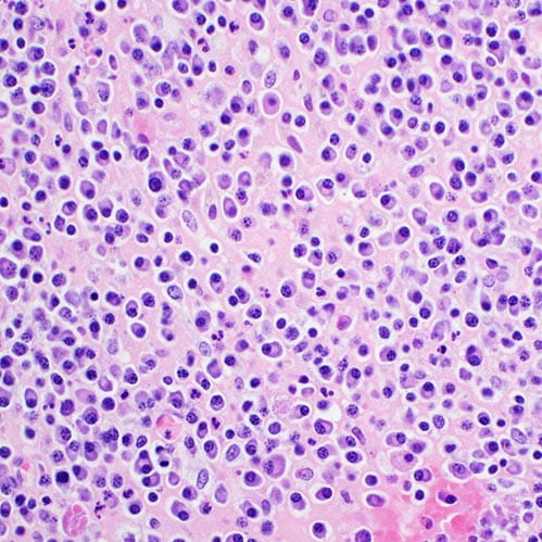 H&E stain, light microscopy, multiple myeloma