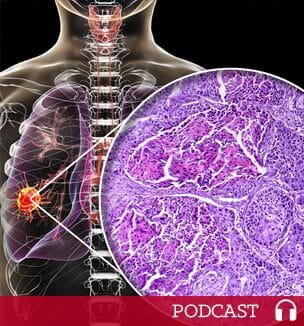 non-small cell lung cancer