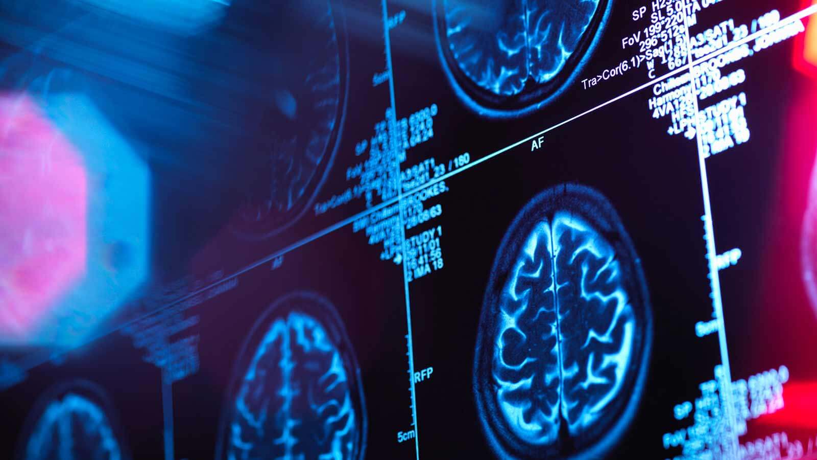 human brain scan in a neurology clinic
