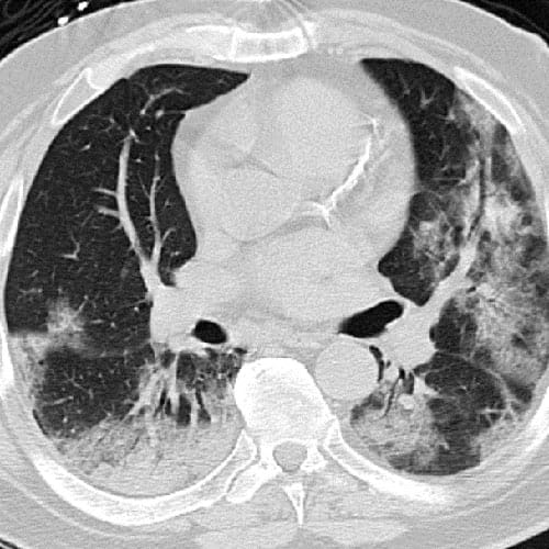 CT scan