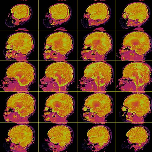 MRI/MRF image