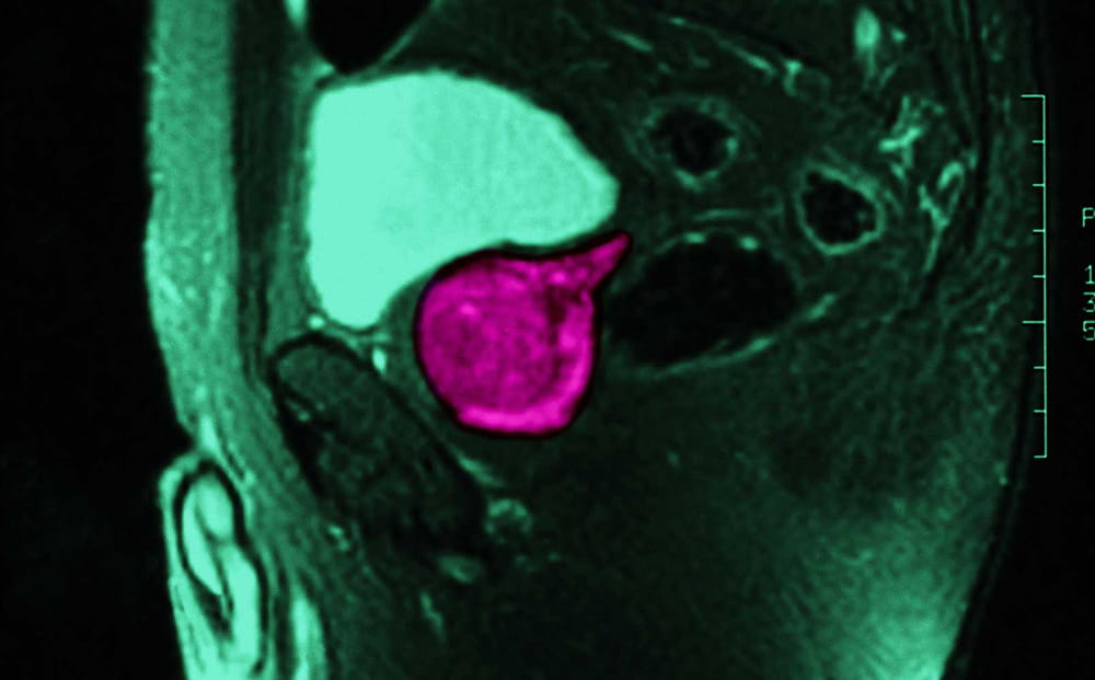 MRI of prostate