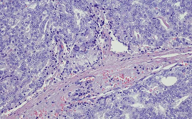prostate cancer