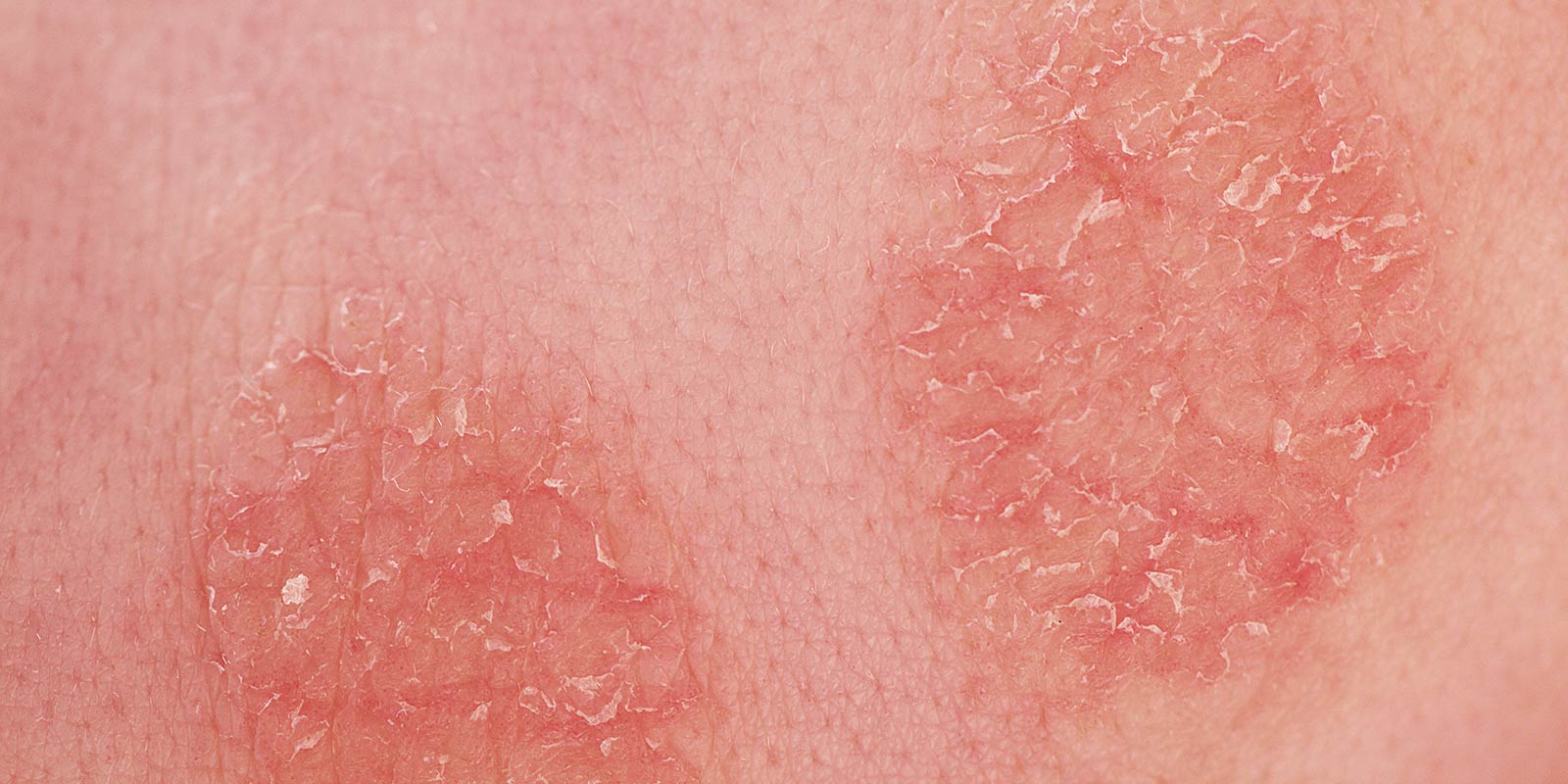 Closeup of child with skin lesions