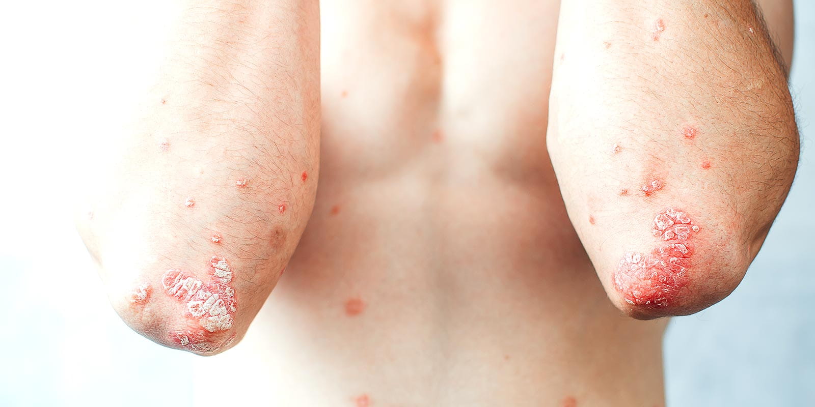 A young teenager displays psoriasis on the elbows