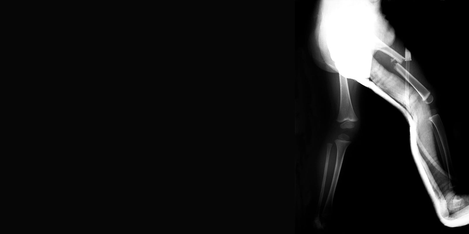 X-Ray of a child’s broken leg